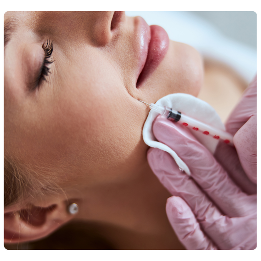 Relleno del Surco Nasogeniano