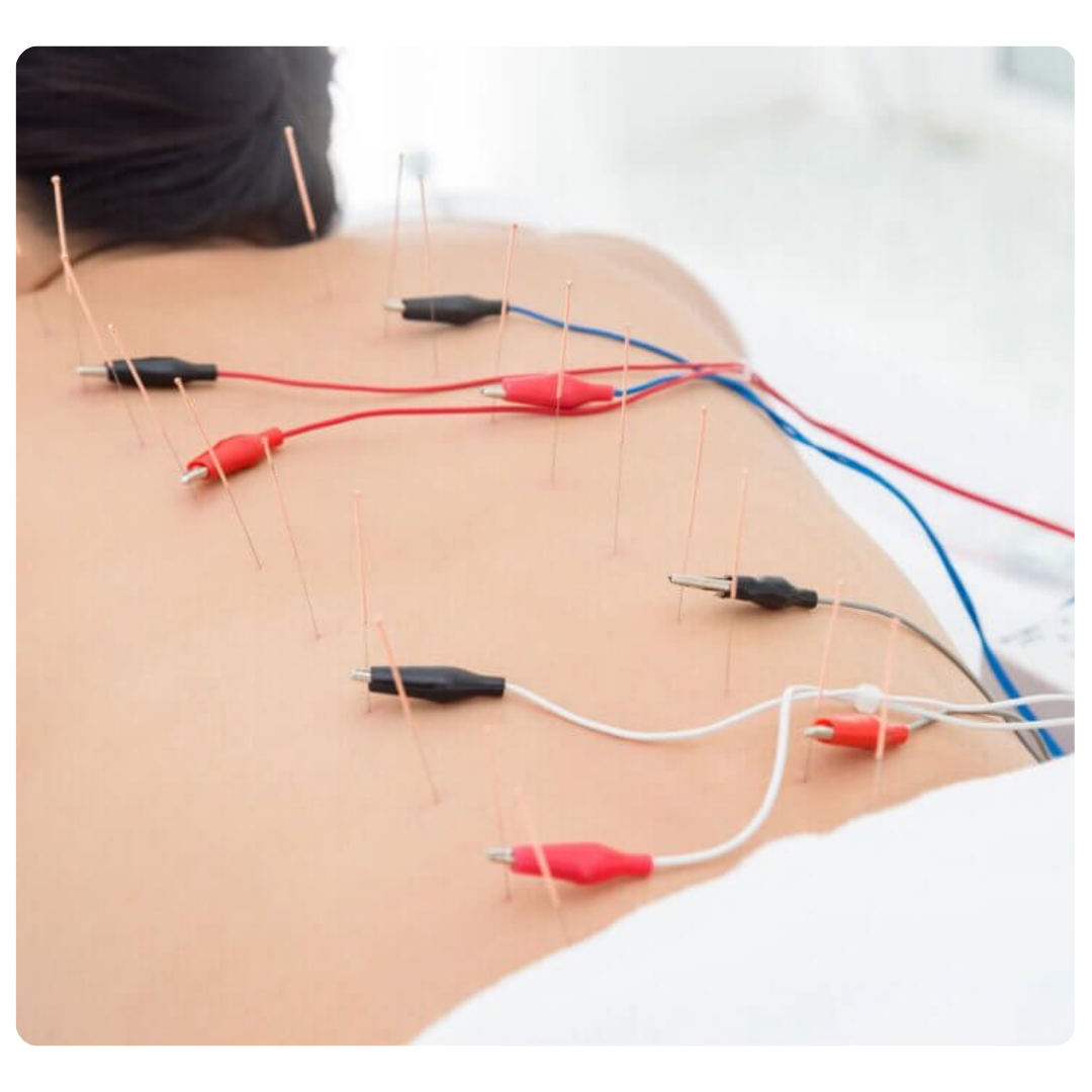 Punción Seca Neuro modulación percutánea (NMP)